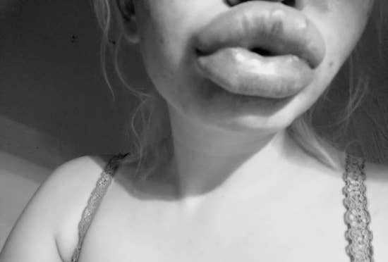 22-Year-Old Instagram Model Wants To Have The ‘Biggest Lips In The World,’ Already Had 15 Procedures To Achieve Her ‘Goal’ 14