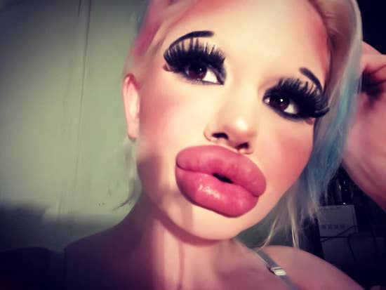 22-Year-Old Instagram Model Wants To Have The ‘Biggest Lips In The World,’ Already Had 15 Procedures To Achieve Her ‘Goal’ 152