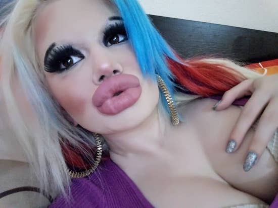 22-Year-Old Instagram Model Wants To Have The ‘Biggest Lips In The World,’ Already Had 15 Procedures To Achieve Her ‘Goal’ 141