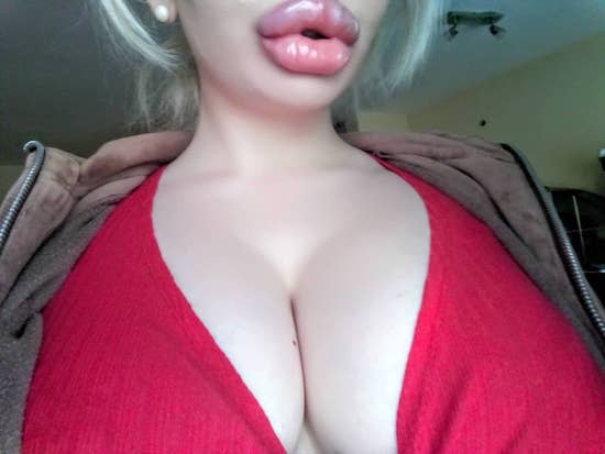 22-Year-Old Instagram Model Wants To Have The ‘Biggest Lips In The World,’ Already Had 15 Procedures To Achieve Her ‘Goal’ 7