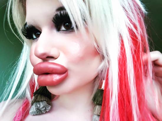 22-Year-Old Instagram Model Wants To Have The ‘Biggest Lips In The World,’ Already Had 15 Procedures To Achieve Her ‘Goal’ 9