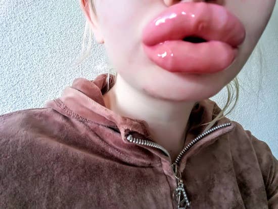 22-Year-Old Instagram Model Wants To Have The ‘Biggest Lips In The World,’ Already Had 15 Procedures To Achieve Her ‘Goal’ 11